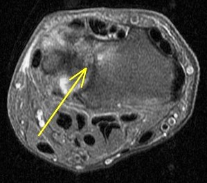 Figure 4 for case Ulnar impingement syndrome